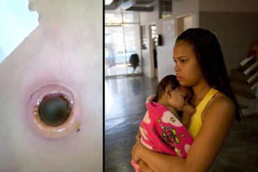 ¡INCREÍBLE! Sacan más de 60 gusanos del ombligo de un bebé por contaminación en el hospital