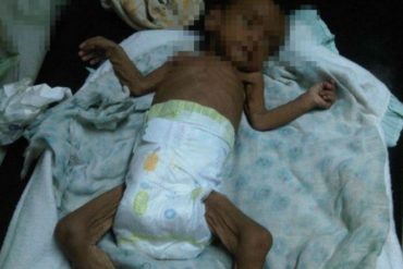 ¡INDIGNANTE! Bebé de 13 meses falleció en el Hospital Dr. José María Vargas por desnutrición