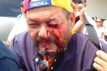 ¡REPRESIÓN REPUDIABLE! Dirigente de Primero Justicia pierde un ojo durante la Toma de Venezuela en Barinas (+Video)