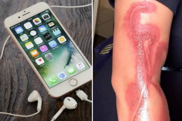 ¡QUÉ HORROR! Mujer sufrió graves quemaduras tras quedarse dormida con su iPhone 7 bajo el brazo
