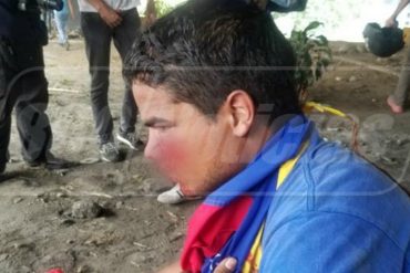 ¡QUÉ HORROR! Joven resultó herido con un perdigón en la cara durante manifestación opositora