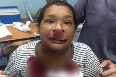 ¡LO ÚLTIMO! Murió mujer que resultó herida por lacrimógena durante disturbios en Naguanagua