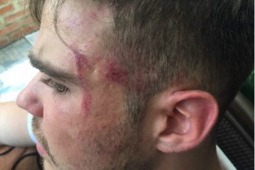 ¡ATENCIÓN! Herido en la cabeza el músico Salomón Ackerman durante la represión de este #10M