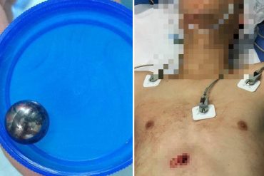 ¡SALVAJISMO! Un joven herido por impacto de esfera metálica en el abdomen en Altamira (Video)