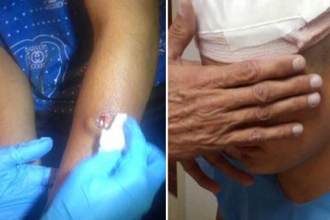 ¡ZOZOBRA! Arremeten brutalmente contra vecinos de La Sucre: Reportan más de 40 heridos, la mayoría por metras
