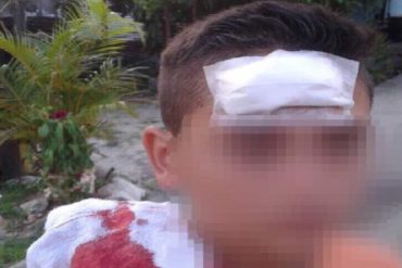 ¡BESTIAS! GNB hirió con perdigón en la cabeza a niño de 11 años durante protesta en Táchira