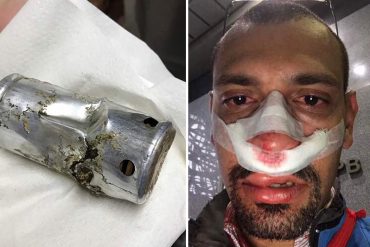 ¡ENTÉRESE! Fotógrafo independiente resultó herido tras brutal represión: PNB le disparó en la cara (Fotos)