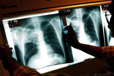 ¡MUY ATENTOS! Detectan nuevo caso de tuberculosis en Vargas