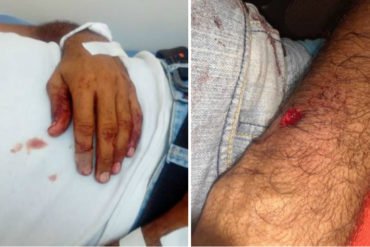 ¡QUÉ HORROR! Reportero Julio Colmenárez resultó herido por las fuerzas del régimen este #30Abr (+Fotos)