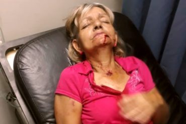 ¡QUÉ TERRIBLE! Un abuelita resultó herida por un perdigonazo en la cara en Vargas (+Fotos fuertes)