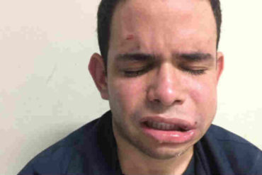 ¡TERRIBLE! Venezolano en Perú denuncia que recibió golpiza en un ataque xenófobo (+Fotos de como quedó)