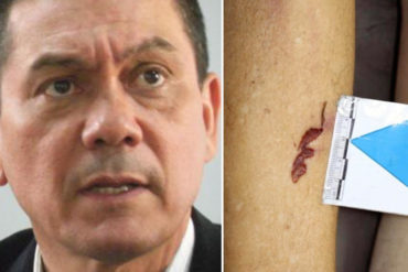 ¡GRAVE! Filtran evidencias de tortura en el cuerpo de Fernando Albán antes de caer al vacío (+Videos+ Fotos FUERTES)