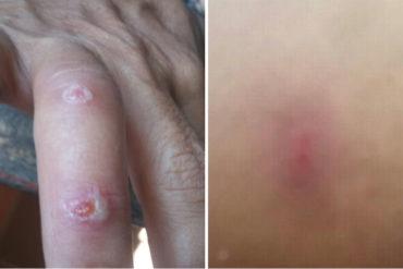 ¡SEPA! Reportan 3 casos de picadura del mosquito “Tábano” en Barquisimeto (+Síntomas que causa +Fotos)