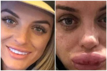 ¡HORROR! Una mujer casi pierde sus labios tras aplicarse unas peligrosas inyecciones de bótox (+Fotos)