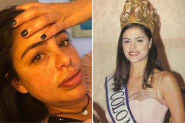 ¡GRAVE! Miss Universo 2000 mostró los estragos que causaron los biopolímeros en su rostro (+Fotos)