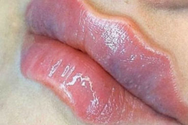 ¡VEA!  ‘Labios del diablo’: Alertan de una peligrosa moda estética que llega desde Rusia (+Fotos)