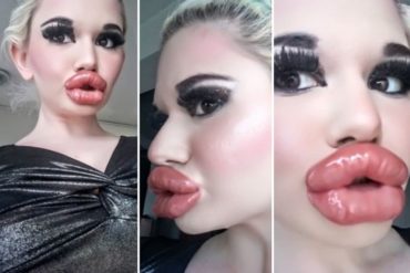 ¡LE CONTAMOS! La “Barbie humana” se inyectó ácido hialurónico para tener los labios “más grandes del mundo” y ahora enfrenta serias consecuencias