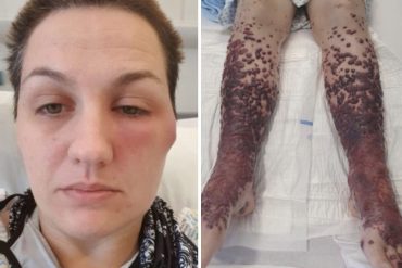 ¡DEBE SABERLO! Las piernas de una mujer se llenaron con ampollas de sangre después de recibir la vacuna de AstraZeneca (+Imágenes fuertes)