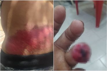 ¡QUÉ FUERTE! Denuncian que policías agredieron a un hombre en Valencia sin motivo: “Lo golpearon por todo el cuerpo, le mutilaron la mitad de un dedo”