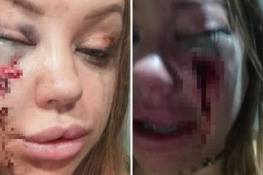 ¡MUY FUERTE! La brutal golpiza que recibió una mujer tras discusión en la primera cita con un hombre que conoció por internet (+Fotos sensibles)