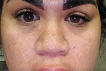 Se fue a hacer un maquillaje permanente en las cejas y terminó con el rostro deformado: ahora comparte su testimonio para prevenir a otras mujeres