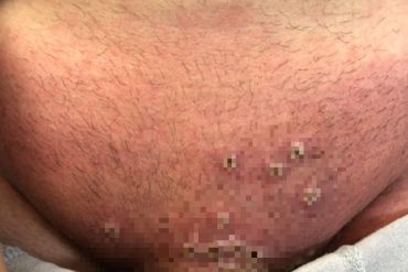 “Da miedo. Mucho miedo”: Así reaccionó un dermatólogo tras ver 3 casos de viruela del mono