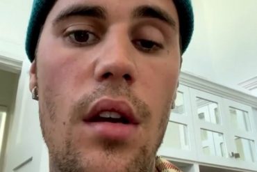 «Manténgame en sus oraciones»: Justin Bieber impactó a sus fanáticos al mostrar la parálisis facial que sufre por una rara enfermedad (+Video)