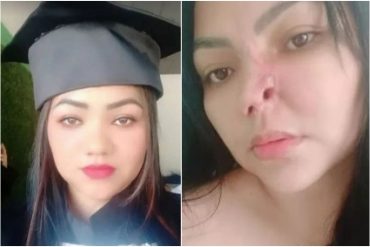 Mujer quedó con el rostro deformado tras una cirugía de nariz: desconocía que quien la operó no era médico, sino odontólogo