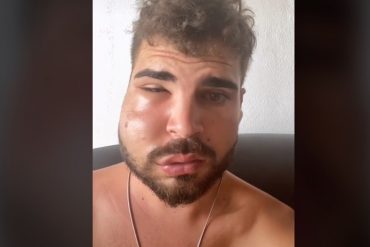 Sintió un fuerte dolor en una muela, fue a una clínica y salió con el rostro deformado: “Nunca supe qué me hicieron” (+Video)