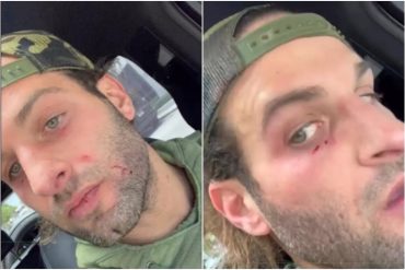 Revelan fotos de cómo quedó el rostro de Miguel Mawad luego de la presunta agresión que sufrió de la modelo venezolana Génesis Aleska