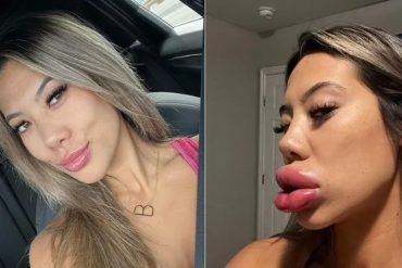 Fue con la ilusión de aumentar sus labios a un centro de estética y terminó de urgencias en el hospital