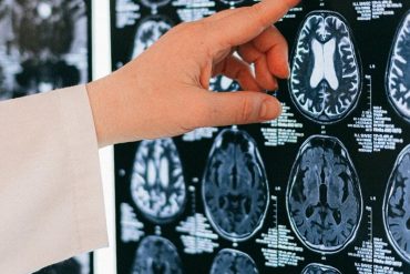 Comunidad científica impactada tras diagnosticar con alzheimer a un joven de 19 años