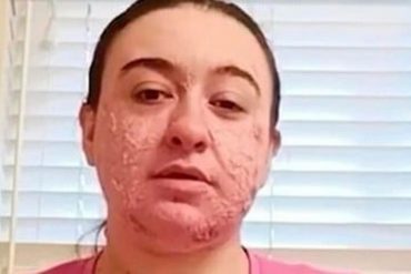 “Me llaman Freddy Krueger”: Mujer sufre bullying por una rara patología de su piel