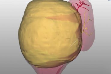 Extirpan un tumor de 2 kilos del hígado de una niña de 10 meses