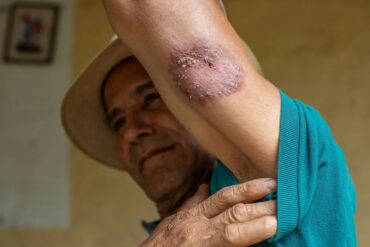 En Monagas detectaron 27 casos de Leishmaniasis: afirman que están bajo tratamiento (+Datos)