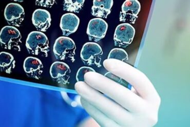 Personas con covid prolongado exhiben cambios cerebrales, según estudio