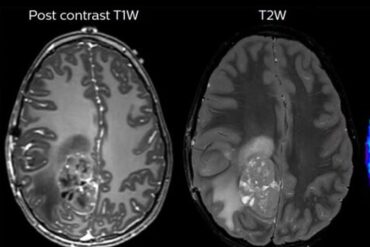 Desarrollan minúsculos microbots para atacar tumores cerebrales para “encogerlos o destruirlos”