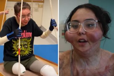 La historia de una adolescente a la que le amputaron las piernas tras quemadura química: “Peleé por mi vida, no me quise ir” (+Video)